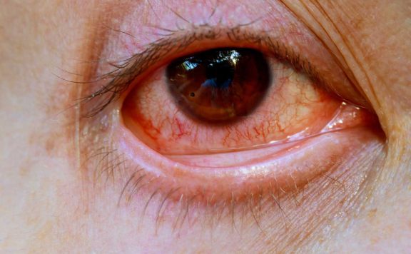Why does using cannabis give you red eyes